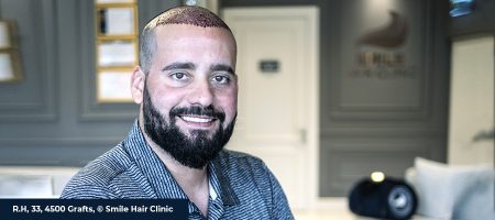 AFTER HAIR TRANSPLANT 01