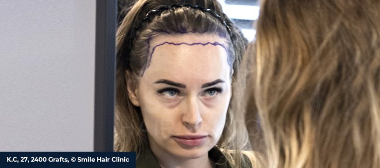 The Causes, Diagnosis and Treatments of Female Hair Loss