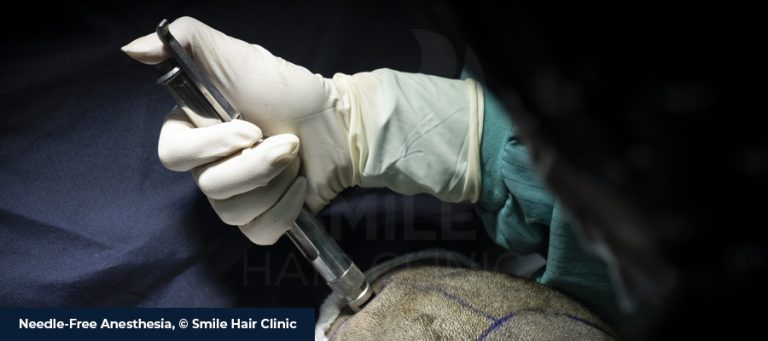 Needle-Free Anesthesia in FUE Hair Transplantation