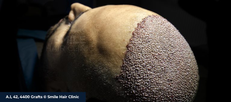 The Effect of The Number of Graft