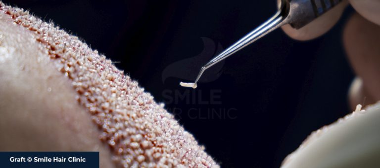 What is a Hair Graft?