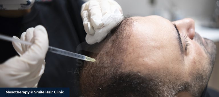 Hair Transplant and Local Anesthesia