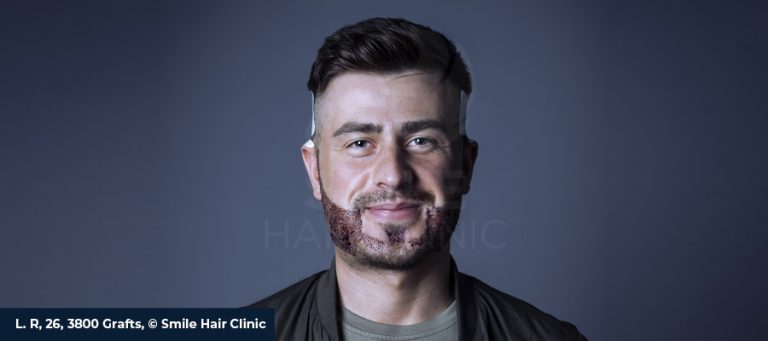 Beard Transplant