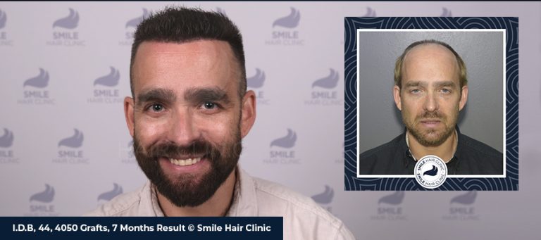 Haartransplantation Vorher-Nachher-Bilder