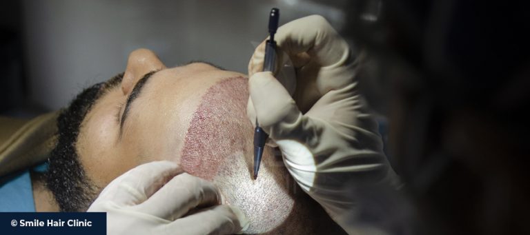 Manuelle Fue-Haartransplantation