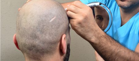 prima-delloperazione-di-trapianto-di-capelli