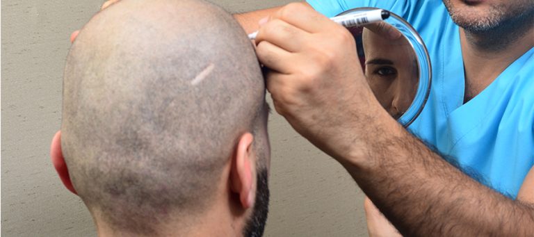 לפני ניתוח השתלת שיער