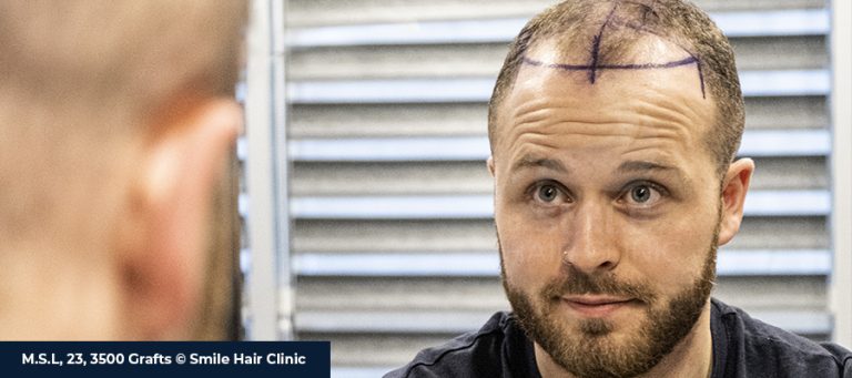 MÄNNLICHER HAARAUSFALL