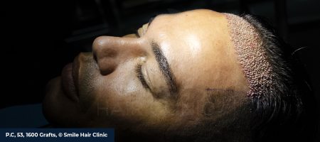 Unshaven-Hair-Transplant-02