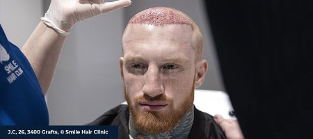 HAIR TRANSPLANT SIDE EFFECTS