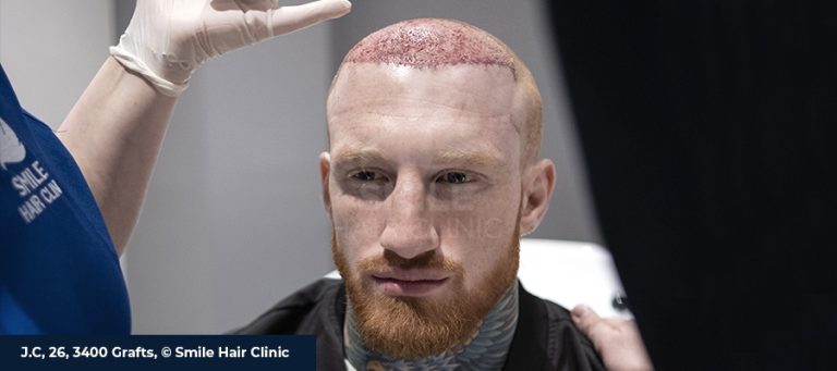 Saç Ekimi Yan Etkileri