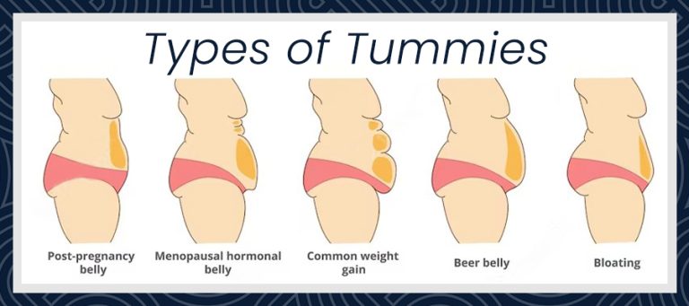 What is a Tummy Tuck Turkey?