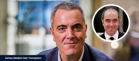 James-Nesbitt-Before-After
