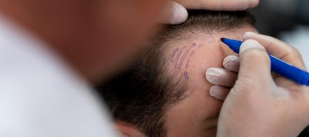 affordable-hair-transplant