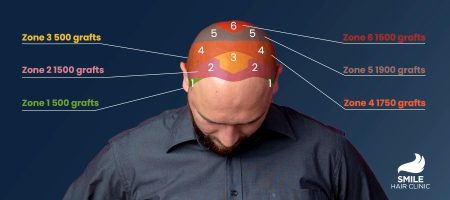 how-many-grafts-do-i-need-for-my-hair-transplant