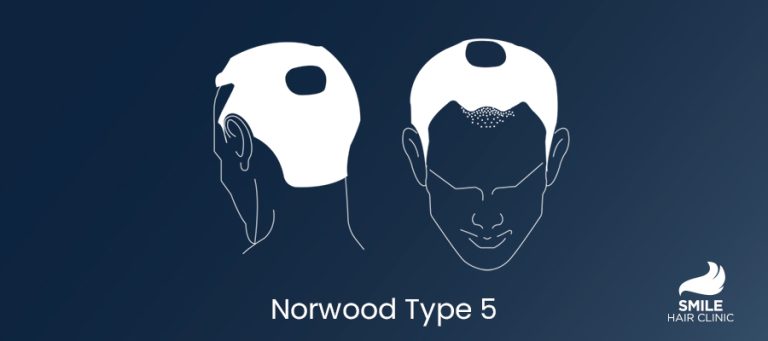 Norwood 5 Type Hair Loss