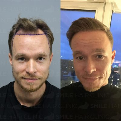 3300 Grafts - J. VOLDUM