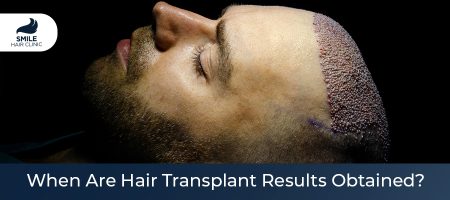 Does-Hair-Transplants-Work-