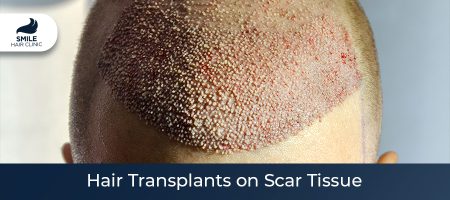 Hair-Transplants-on-Scar-Tissue