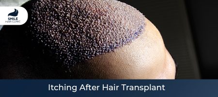 Itching-After-Hair-Transplant