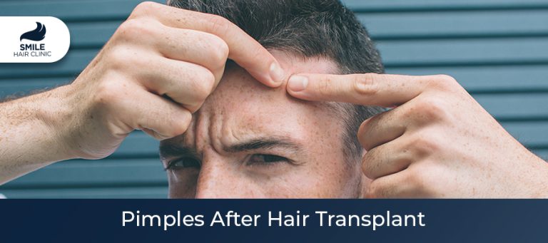 Pimples After Hair Transplant