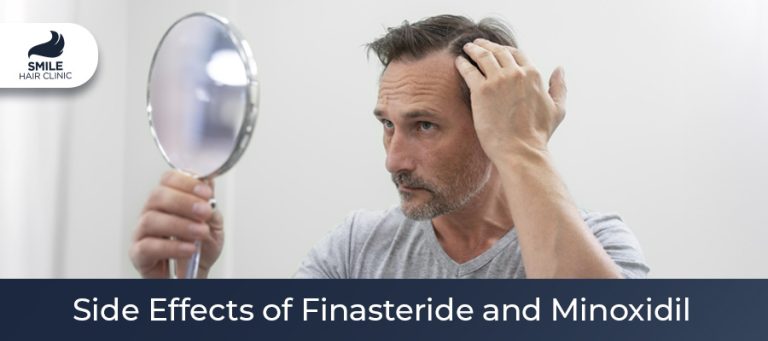 Side Effects of Finasteride and Minoxidil