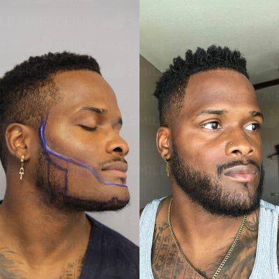 2400 Grafts - A. PAGE