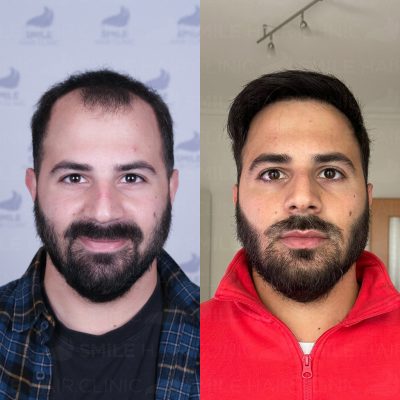 4000 Grafts - A. MONTESANTO