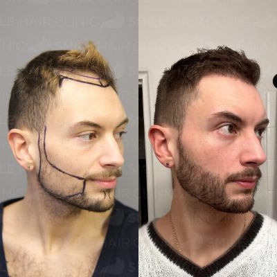 4000 Grafts - H. DIAZ