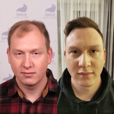 4750 Grafts - J. HESSLER