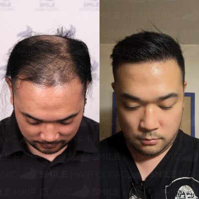 5000 Grafts - J. PINEDA