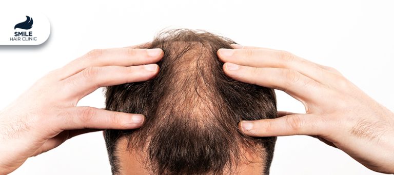 Hair Loss in Menopause and PCOS (Polycystic Ovary Syndrome)