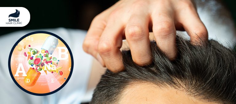 How to Choose the Best Vitamin for Hair Loss