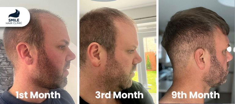 When Will I See Results After a Hair Transplant?