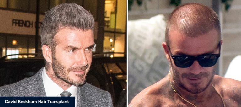 David Beckham Haartransplantation