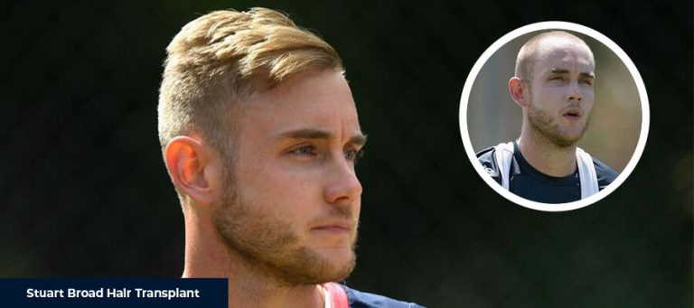El Trasplante Capilar de Stuart Broad