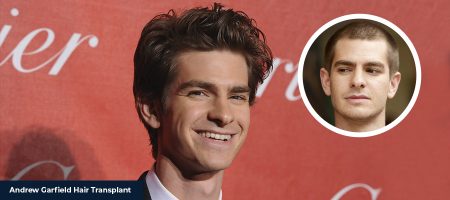 Andrew-Garfield-Hair-Transplant