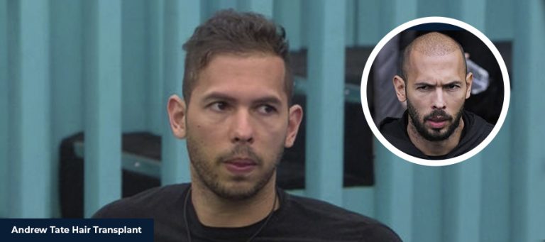 アンドリュー・テイトによるヘア移植