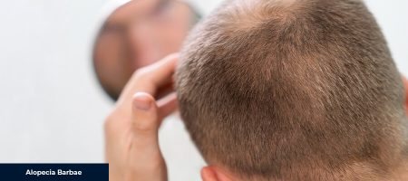 Causes-of-Alopecia-Barbae