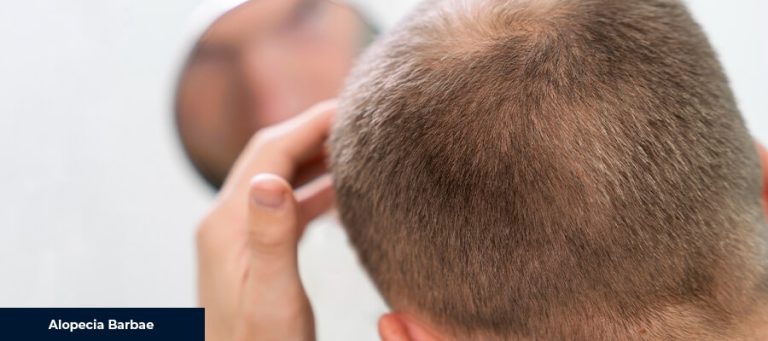 Alopecia Barbae: Causes and Solutions
