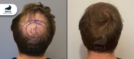 Crown-Hair-Transplant