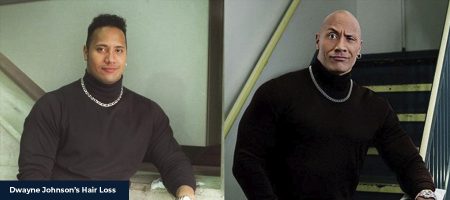 Dwayne-Johnson-Hair-Transplant-1