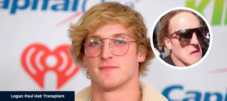 Greffe de cheveux de Logan Paul