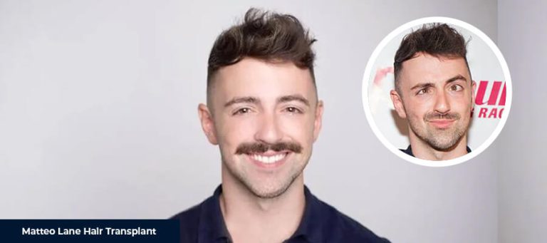 マッテオ・レーンのヘア移植