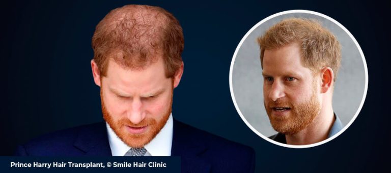 Tout savoir sur la greffe de cheveux du prince Harry