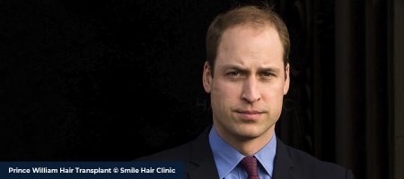 Prince-William-Hair-Transplant-3