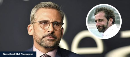 STEVE-CARELL-HAIR-TRANSPLANT-1