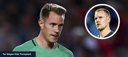 Ter-Stegen-Hair-Transplant-1