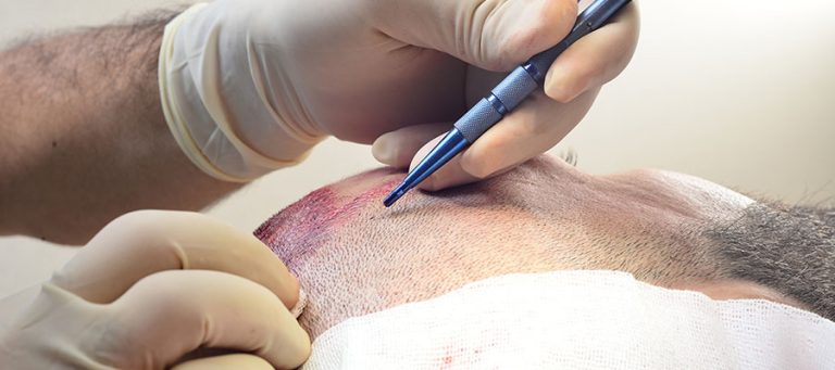 GREFFE DE CHEVEUX FUE