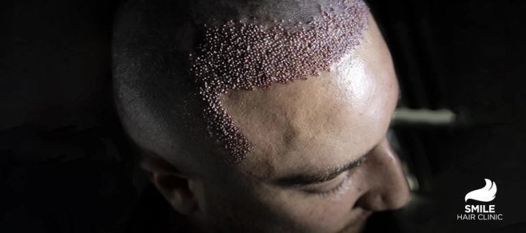 Longevity of Hair Transplants: Factors Influencing the Duration of Results